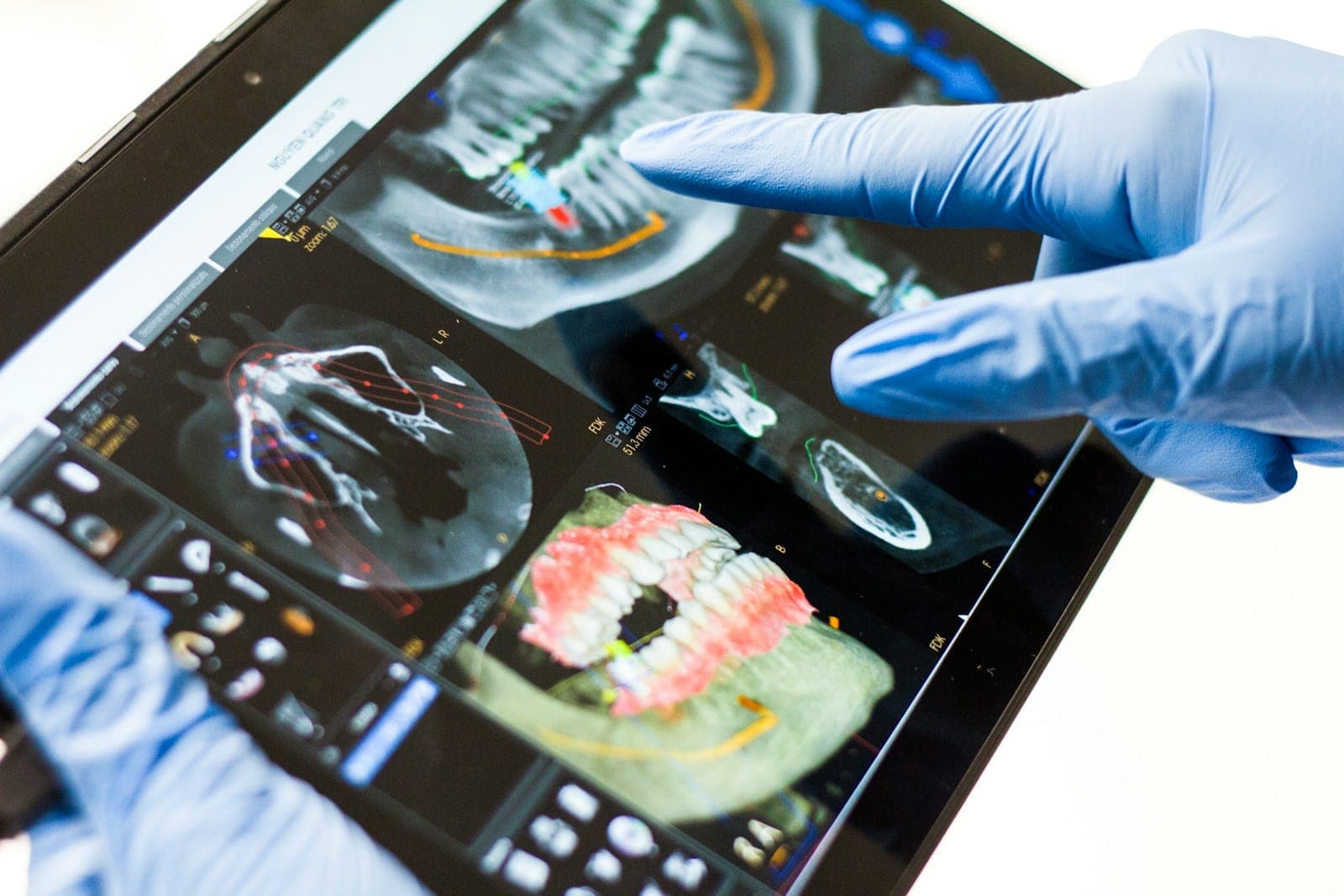 Gloved hands pointing at a 3D digital model of teeth on a tablet screen