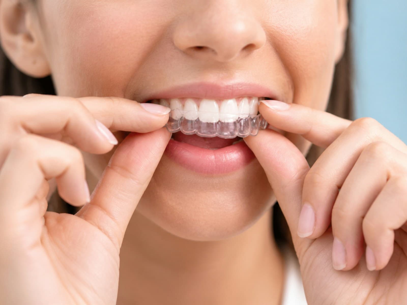A woman fitting a clear aligner over her upper teeth