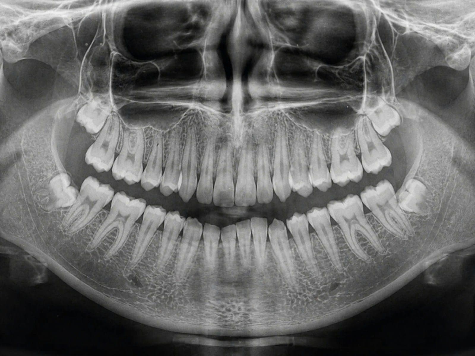 A panoramic dental X-ray showing a full set of teeth and the jawbone