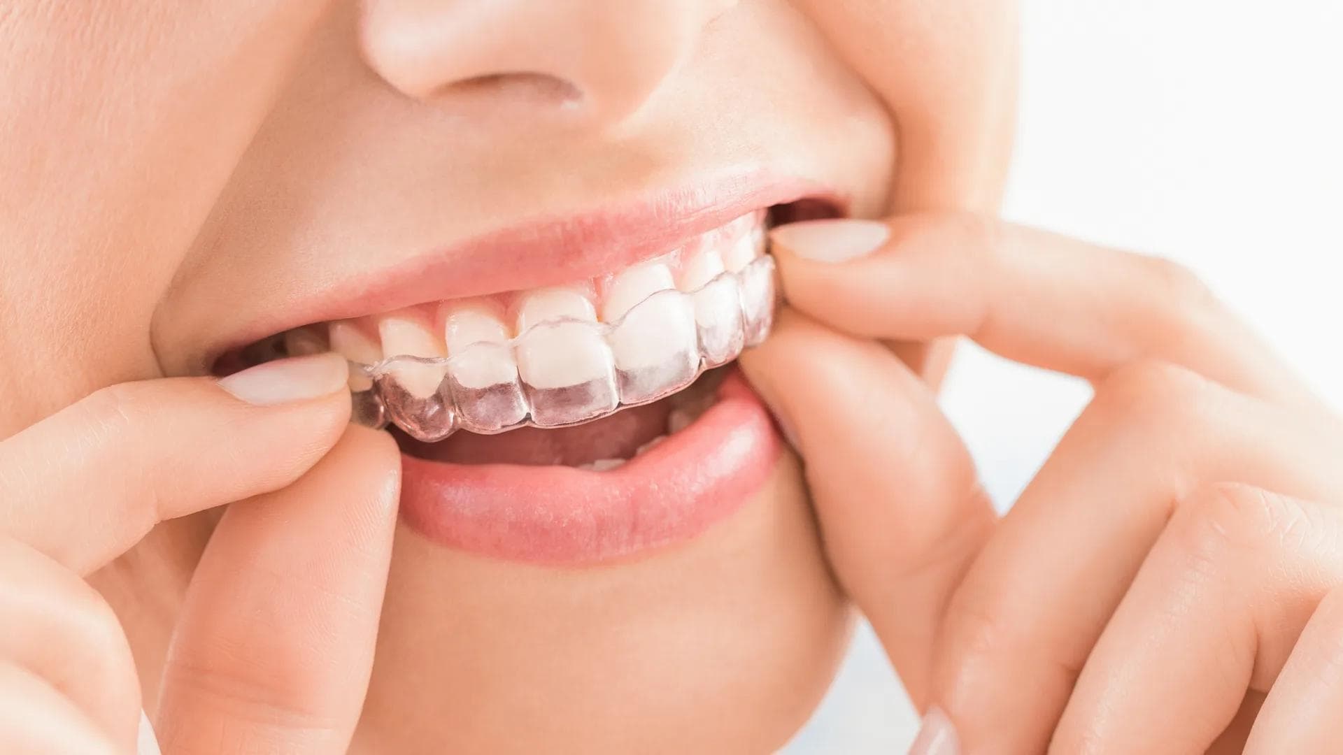 Clear Aligners