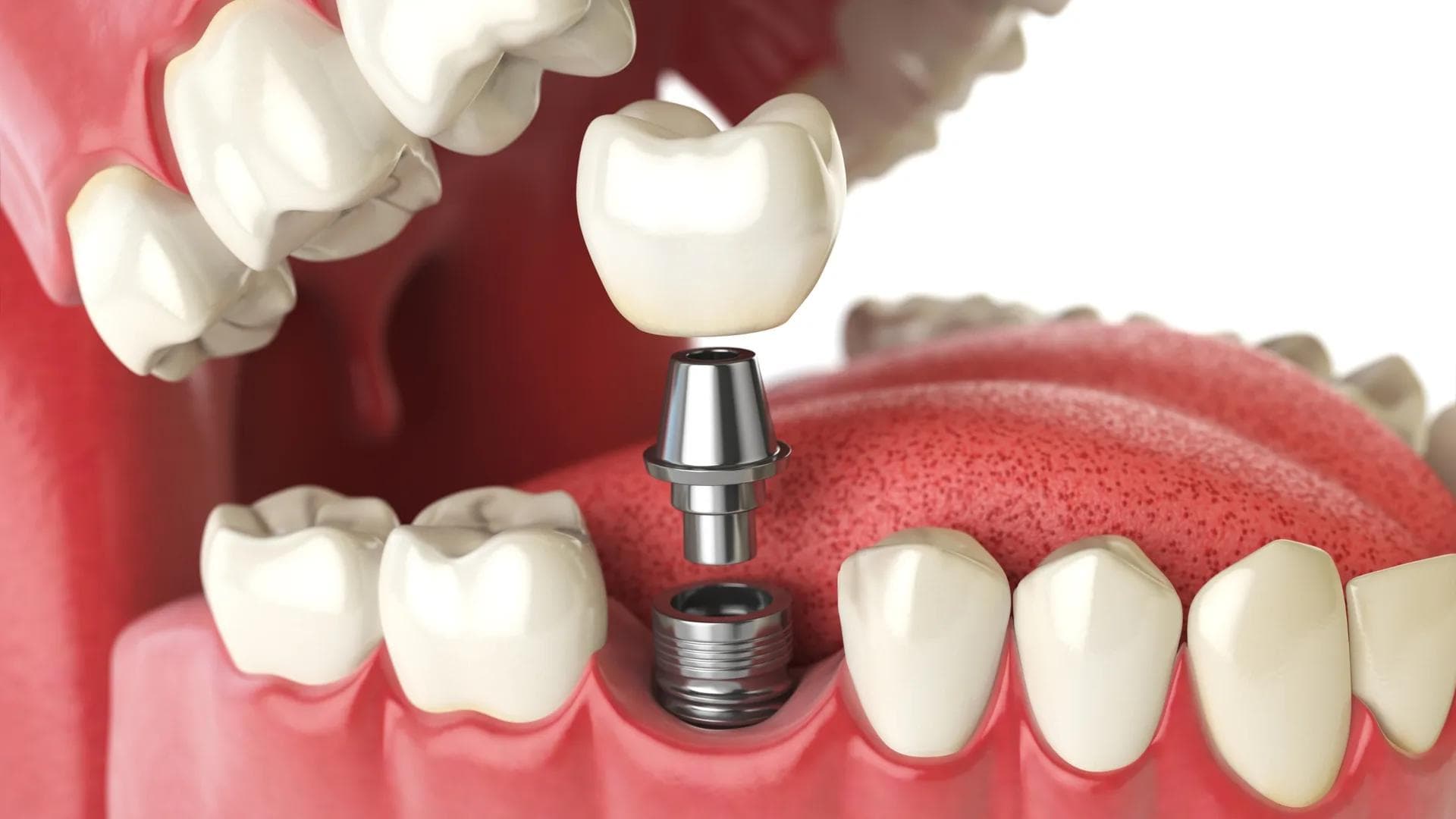 Dental Implants