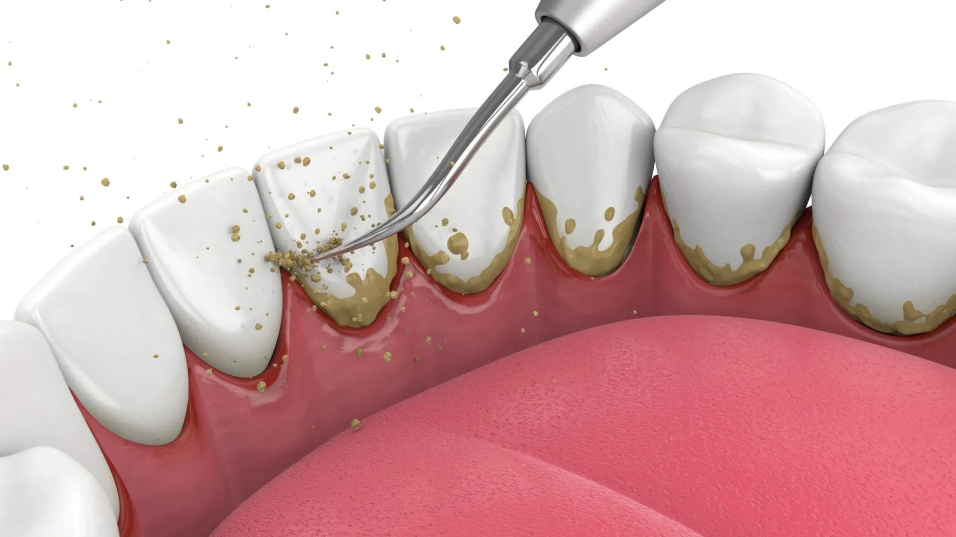 Periodontal Care